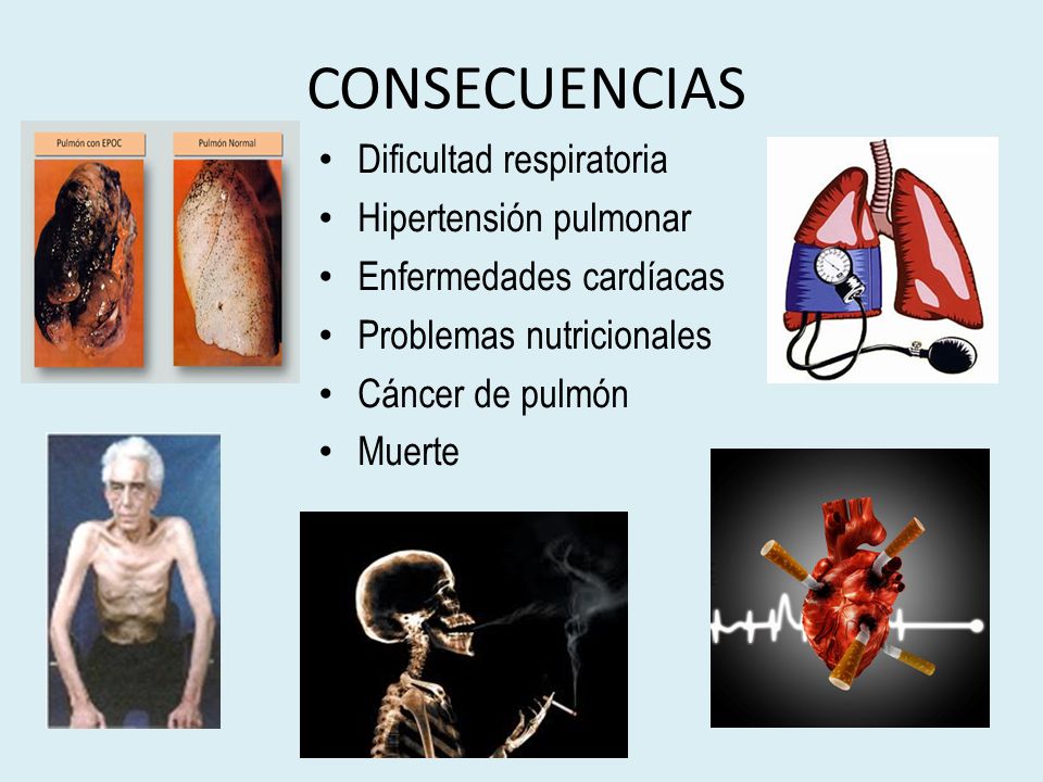 Embolia pulmonar e hipertensión pulmonar Embolia pulmonar e hipertensión pulmonar